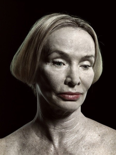 H υπερβολή στο πετσί τους -Ακραίες πλαστικές επεμβάσεις στο φακό του φωτογράφου [εικόνες] | iefimerida.gr 16