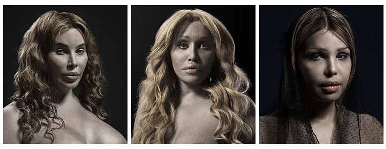 H υπερβολή στο πετσί τους -Ακραίες πλαστικές επεμβάσεις στο φακό του φωτογράφου [εικόνες] | iefimerida.gr 21