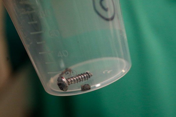 Εβγαλαν βίδες και μεταλλικά θραύσματα από τα θύματα των επιθέσεων στις Βρυξέλλες [εικόνες] | iefimerida.gr 6