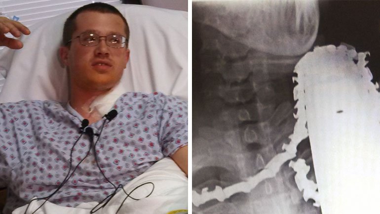 Μεταφέρθηκε στο νοσοκομείο με ένα αλυσοπρίονο καρφωμένο στο λαιμό του και επέζησε -Ενα απίθανο ιατρικό θαύμα [εικόνες] | iefimerida.gr 1