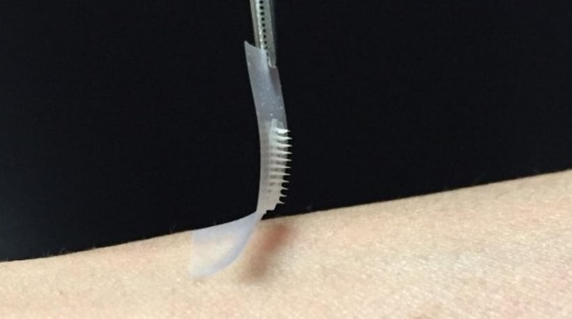 Aυτή είναι η νέα μέθοδος χορήγησης φαρμάκου σε ασθενείς με μελάνωμα [εικόνες] | iefimerida.gr 2