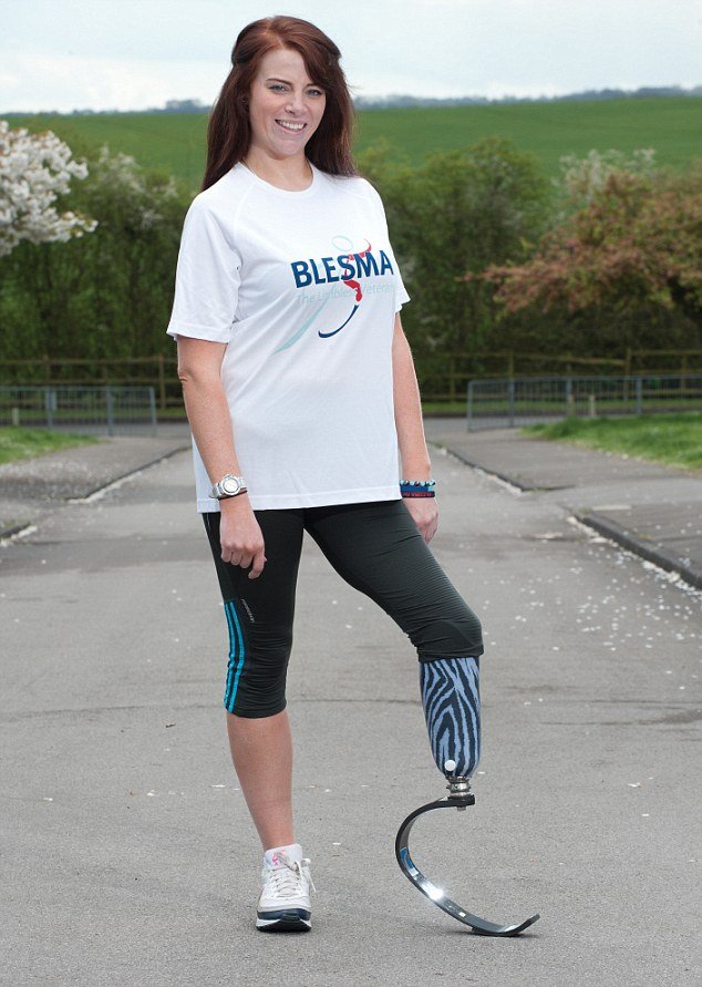 Η βιονική γυναίκα: Στρατιώτης επέζησε από έκρηξη σε πόλεμο και πλήρωσε 62.000 ευρώ για την «ανακατασκευή» της [εικόνες] | iefimerida.gr 3