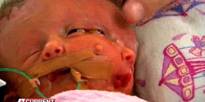 Εφυγε από τη ζωή το βρέφος με τα δύο πρόσωπα [εικόνες] | iefimerida.gr 0