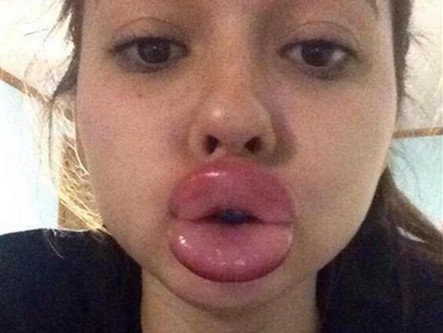 Γέλιο και πόνος -Γιατί οι έφηβοι μανιωδώς προσπαθούν να αποκτήσουν χείλη παπιού [εικόνες] | iefimerida.gr 9