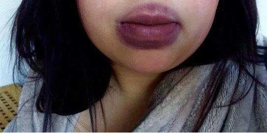 Γέλιο και πόνος -Γιατί οι έφηβοι μανιωδώς προσπαθούν να αποκτήσουν χείλη παπιού [εικόνες] | iefimerida.gr 10