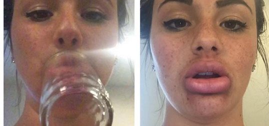 Γέλιο και πόνος -Γιατί οι έφηβοι μανιωδώς προσπαθούν να αποκτήσουν χείλη παπιού [εικόνες] | iefimerida.gr 11