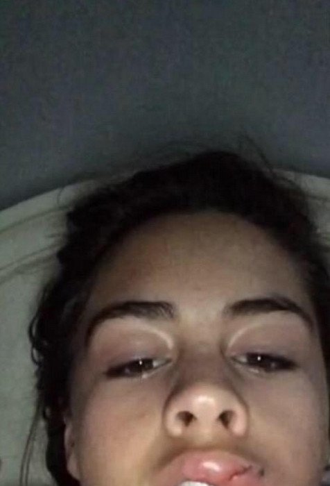 Γέλιο και πόνος -Γιατί οι έφηβοι μανιωδώς προσπαθούν να αποκτήσουν χείλη παπιού [εικόνες] | iefimerida.gr 13