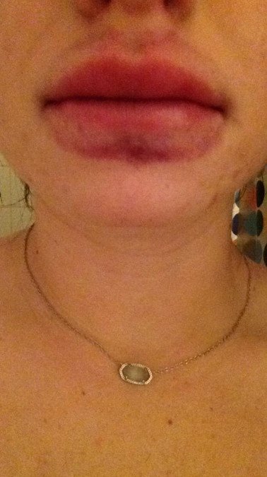 Γέλιο και πόνος -Γιατί οι έφηβοι μανιωδώς προσπαθούν να αποκτήσουν χείλη παπιού [εικόνες] | iefimerida.gr 14