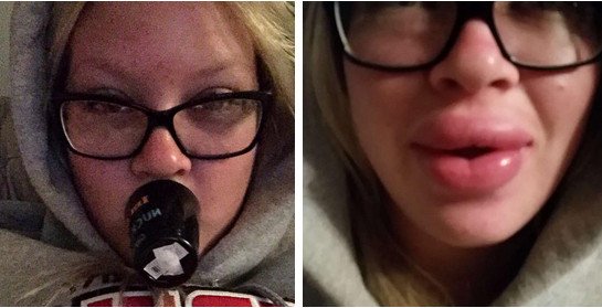 Γέλιο και πόνος -Γιατί οι έφηβοι μανιωδώς προσπαθούν να αποκτήσουν χείλη παπιού [εικόνες] | iefimerida.gr 15