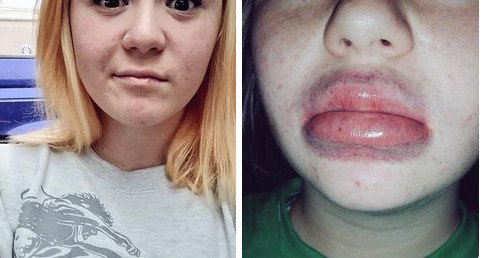 Γέλιο και πόνος -Γιατί οι έφηβοι μανιωδώς προσπαθούν να αποκτήσουν χείλη παπιού [εικόνες] | iefimerida.gr 1