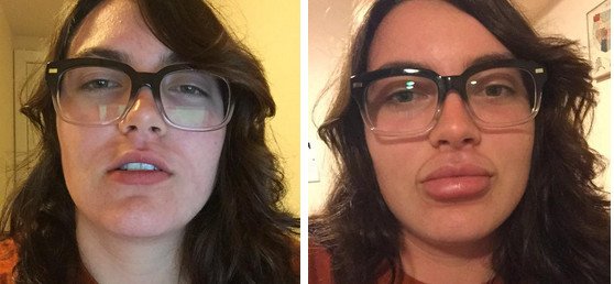 Γέλιο και πόνος -Γιατί οι έφηβοι μανιωδώς προσπαθούν να αποκτήσουν χείλη παπιού [εικόνες] | iefimerida.gr 2