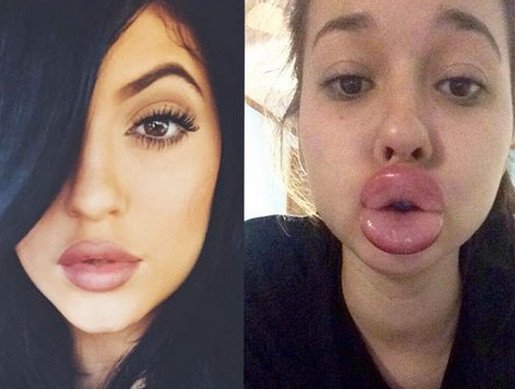 Γέλιο και πόνος -Γιατί οι έφηβοι μανιωδώς προσπαθούν να αποκτήσουν χείλη παπιού [εικόνες] | iefimerida.gr 5