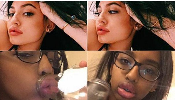 Γέλιο και πόνος -Γιατί οι έφηβοι μανιωδώς προσπαθούν να αποκτήσουν χείλη παπιού [εικόνες] | iefimerida.gr 6