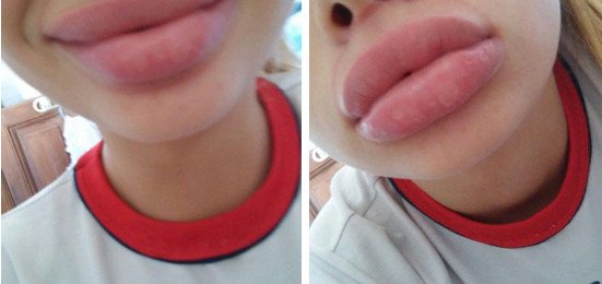 Γέλιο και πόνος -Γιατί οι έφηβοι μανιωδώς προσπαθούν να αποκτήσουν χείλη παπιού [εικόνες] | iefimerida.gr 8