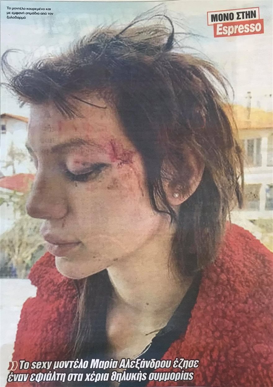 Φωτογραφία που δημοσιεύει η Espresso με το μοντέλο Μαρία Αλεξάνδρου μετά τον ξυλοδαρμό της