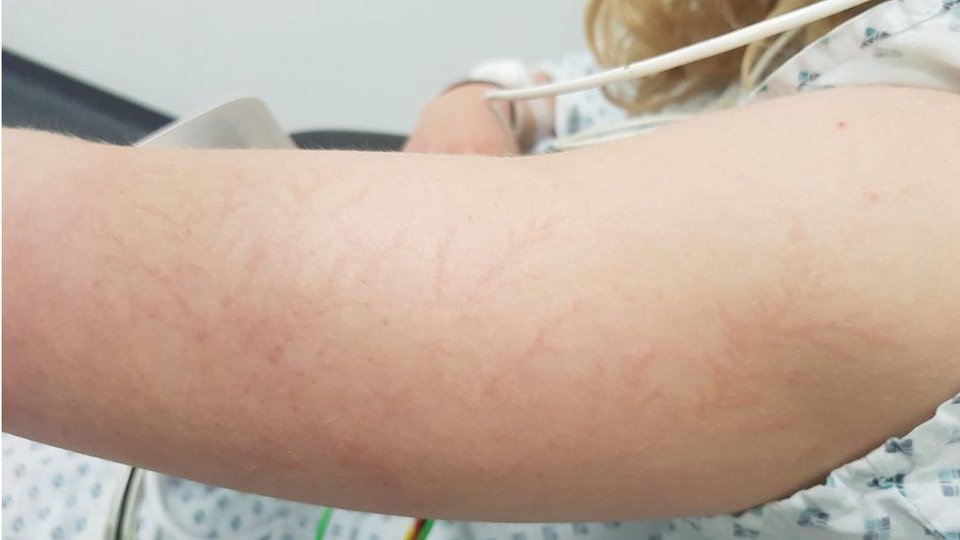 Το χέρι της Ίζομπελ με τα σημάδια Λίχτενμπεργκ