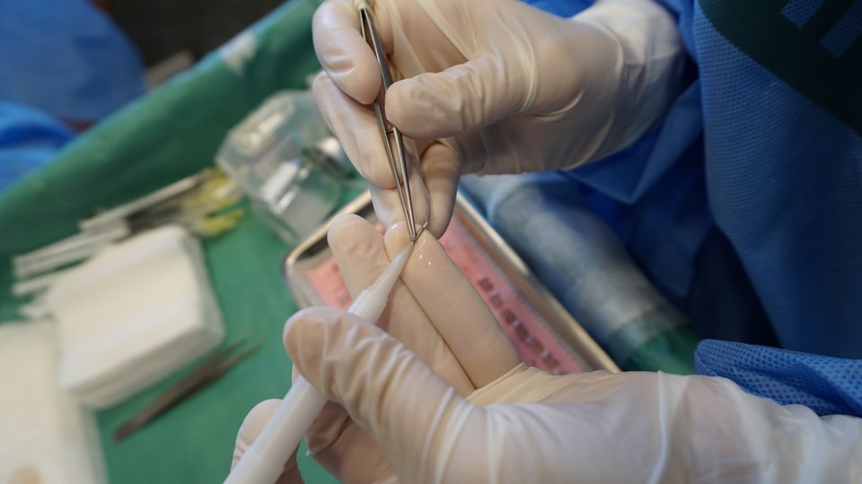 Χάρη στο DHI Implanter επιτυγχάνεται ο πλήρης έλεγχος του βάθους, της κατεύθυνσης και της γωνίας τοποθέτησης των μαλλιών.