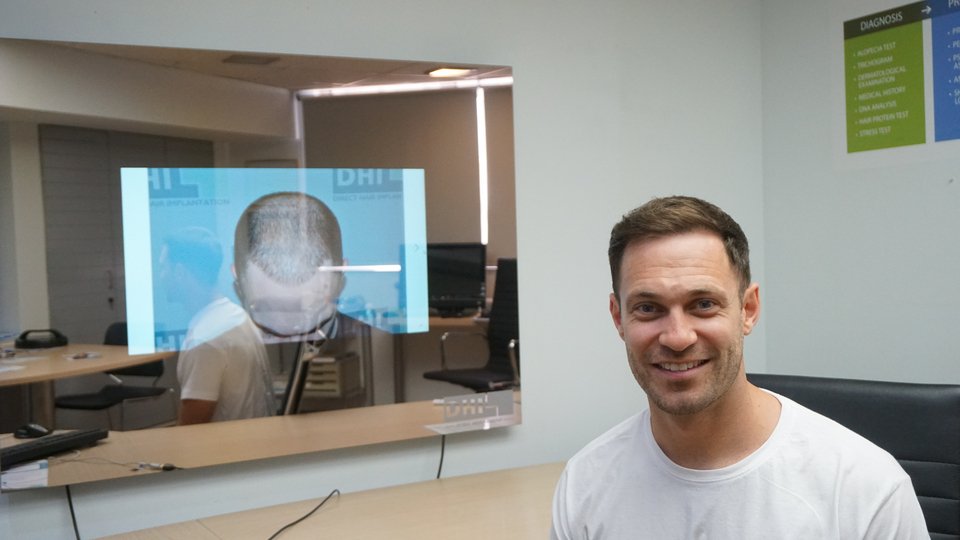 Ο βρετανός ηθοποιός Darragh Kelliher πριν και μετά τη μεταμόσχευση μαλλιών με την τεχνική της DHI.