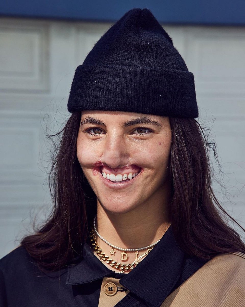 Το 22χρονο μοντέλο δεν έχει καθόλου άνω χείλος μετά την επίθεση από πίτμπουλ