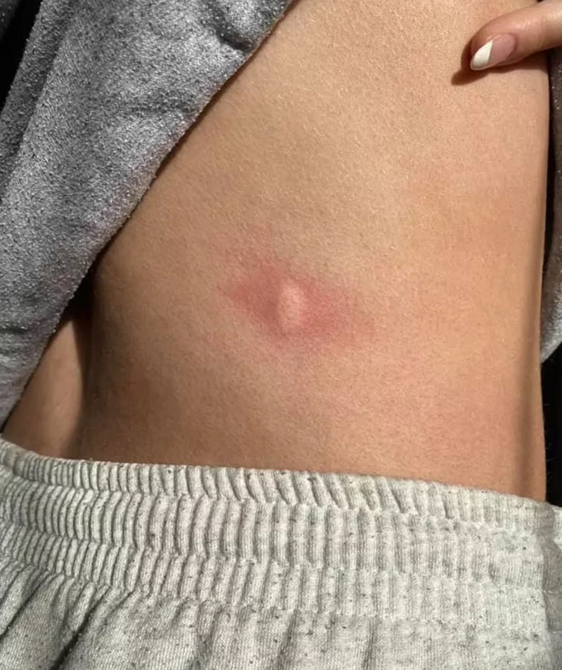 H Tζούλιετ ΜακΓκέοφ δείχνει το σημάδι στην πλάτη της από την επίθεση με βελόνα που δέχθηκε σε κλαμπ στο Ρέντινγκ του Μπέρκσιρ 
