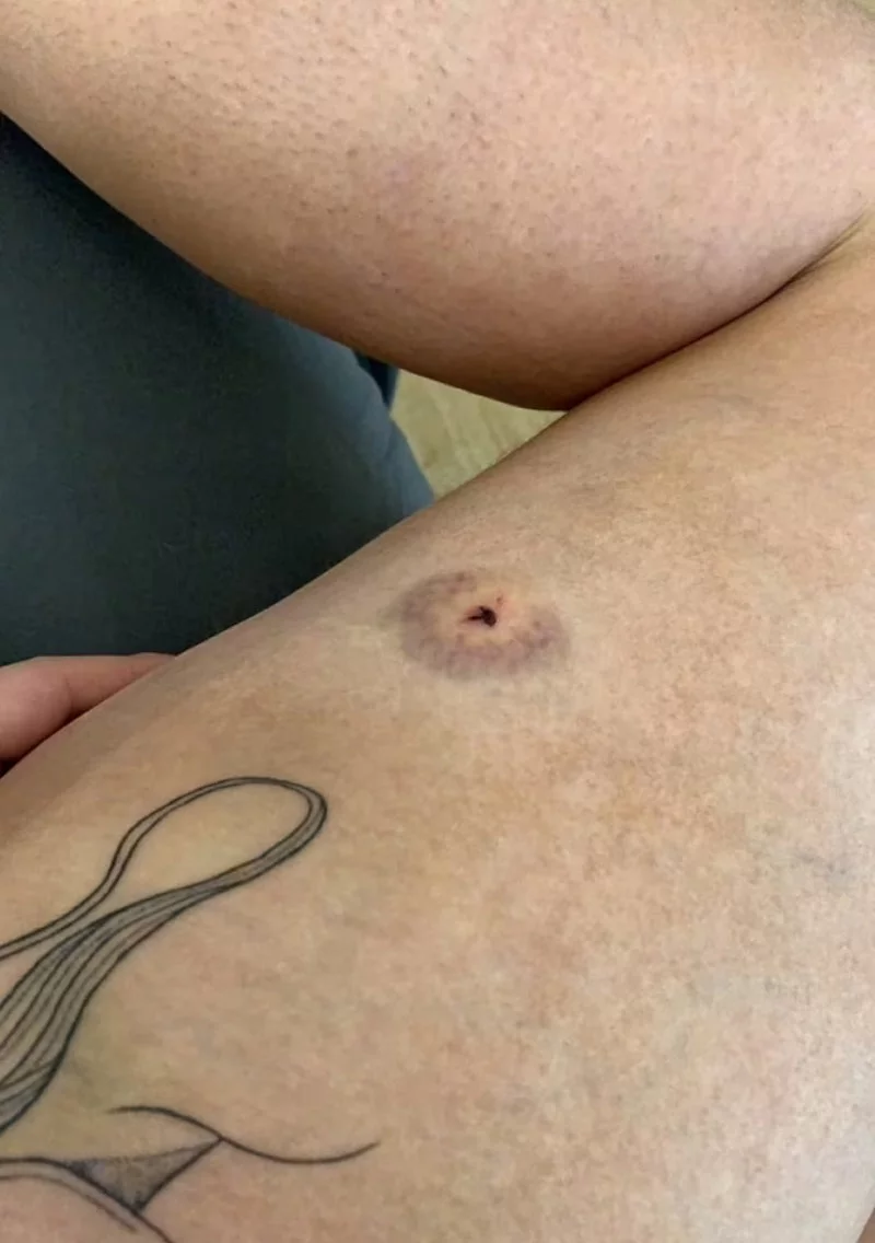 Σημάδι από τρύπημα βελόνας στο πόδι της 20χρονης Κλόι Μάντικο, που κατήγγειλε ότι δέχθηκε επίθεση τον Οκτώβριο  