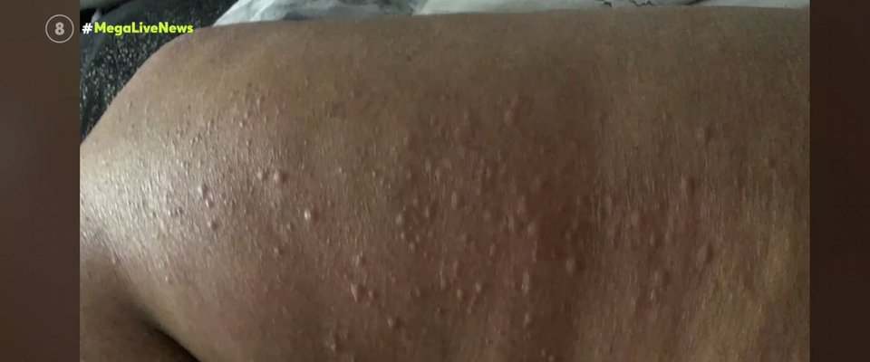 Δερματικά εξανθήματα που εμφανίζει η μετάλλαξη Ομικρον