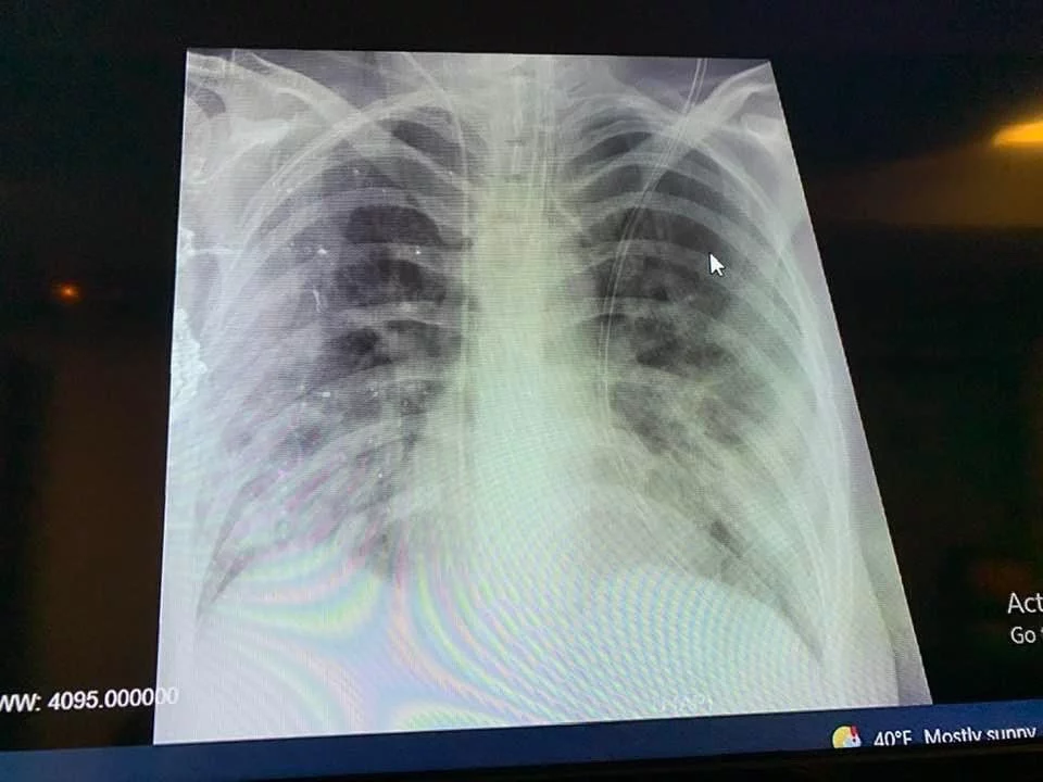 έγκυος, ακτινογραφία πνεύμονα