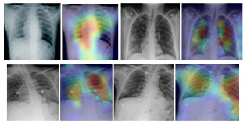 Η τεχνολογία αυτή συγκρίνει ακτινογραφίες υπόπτου φορέα με εκείνες ασθενών της Covid-19, υγιών ατόμων και ασθενών άλλου τύπου ιογενών πνευμονιών