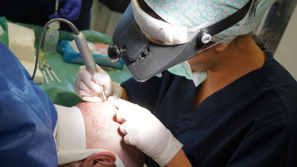 Με την ανώδυνη τεχνική﻿ DHI Direct Hair Implantation, το αποτέλεσμα είναι απόλυτα φυσικό και μόνιμο.