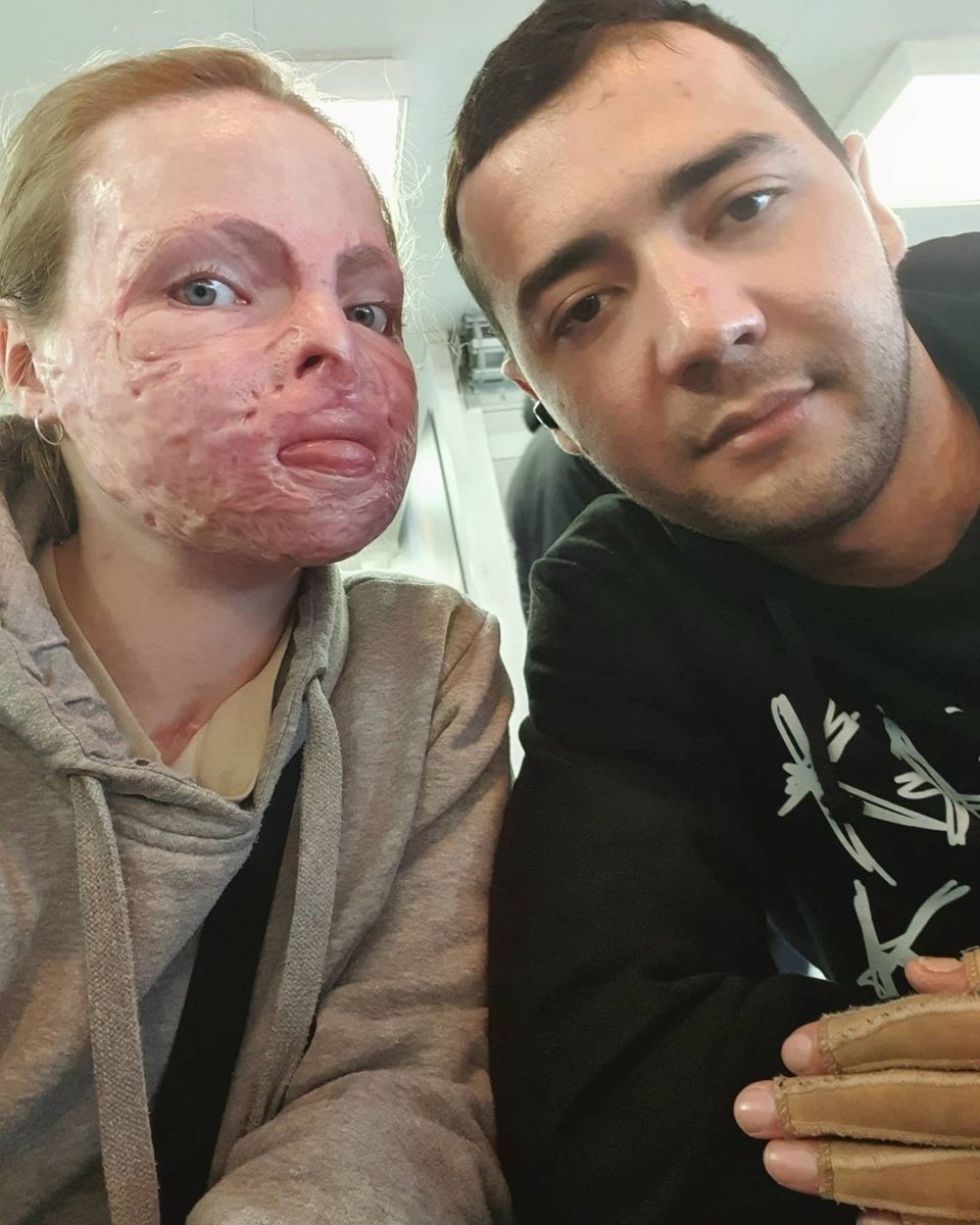 Η Sólrún πίστευε ότι ο φίλος της θα την εγκατέλειπε μόλις θα έβλεπε τα εγκαύματά της 