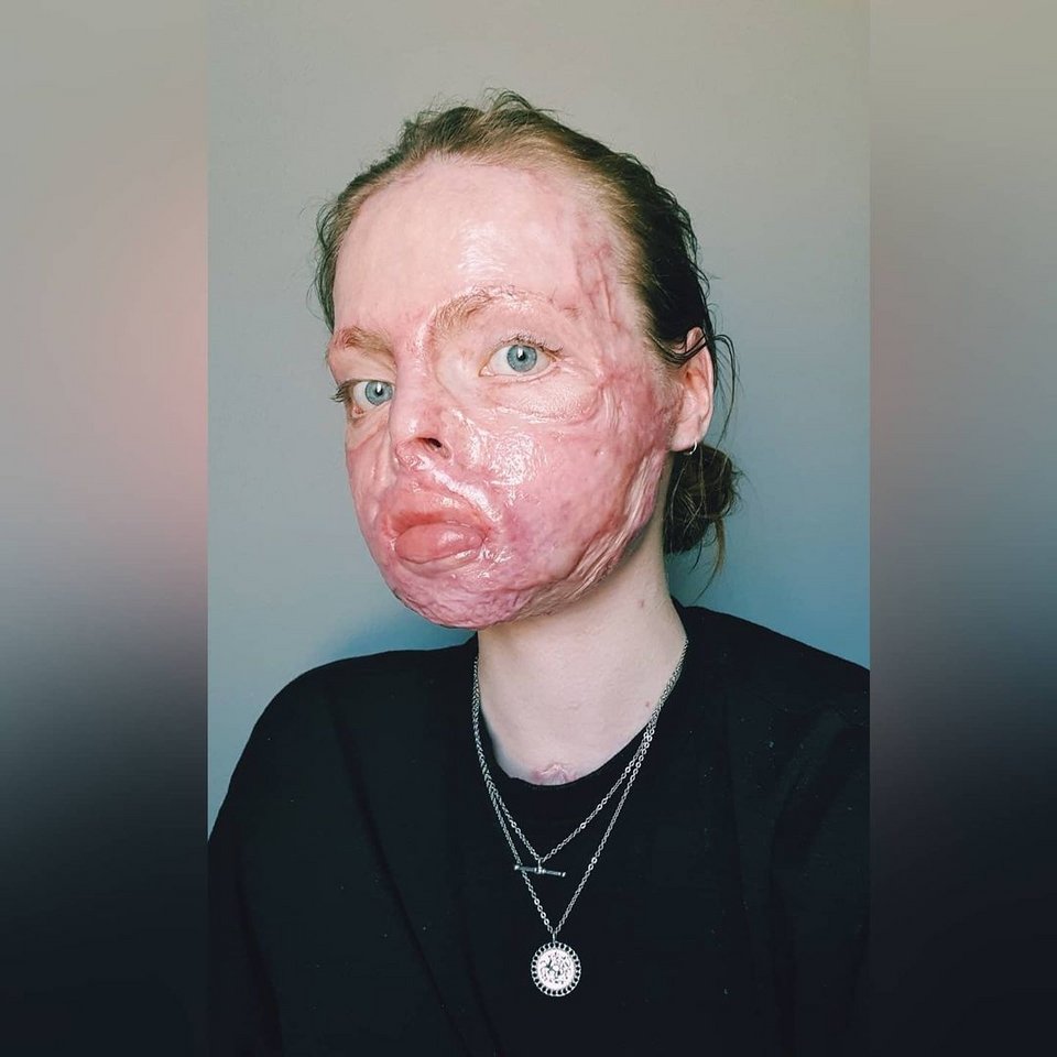 Η Sólrún δεν φοβάται πια να δείξει τα εγκαύματα της