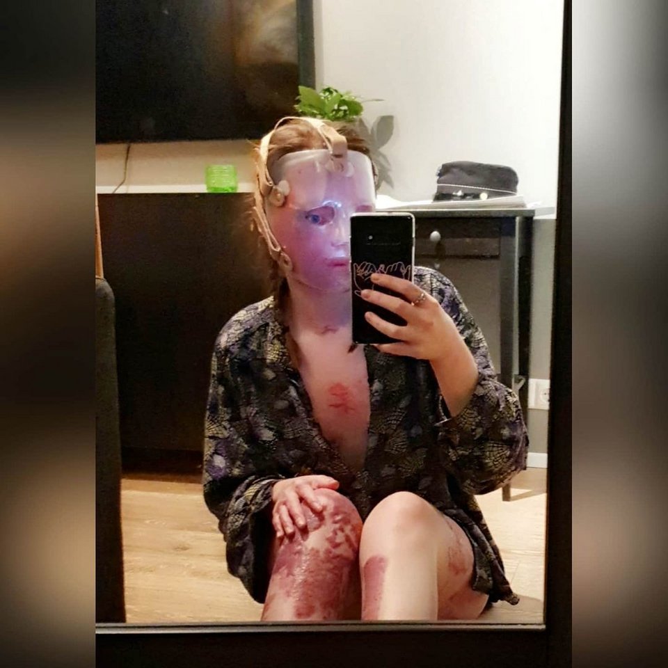 Η νεαρή κοπέλα βγάζει σέλφι δείχνοντας τα εγκαύματά της