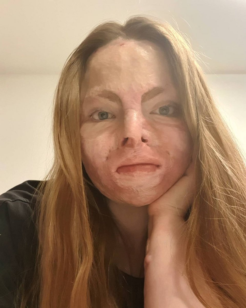 Η 24χρονη Sólrún με τα σημάδια από τα εγκαύματα στο πρόσωπό της