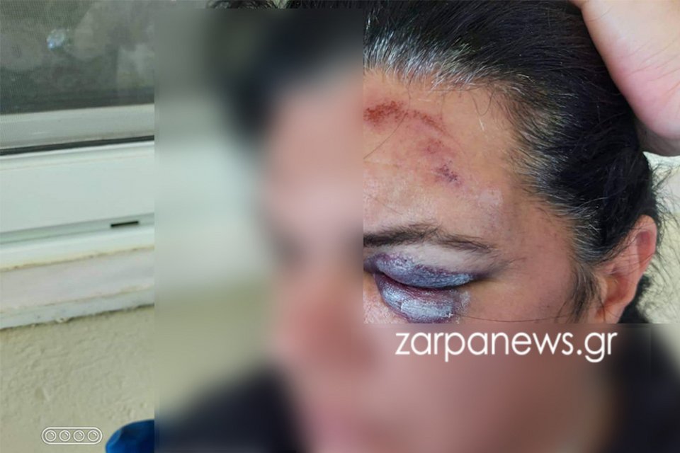 Τα τραύματα της γυναίκας από το τροχαίο στην Κρήτη