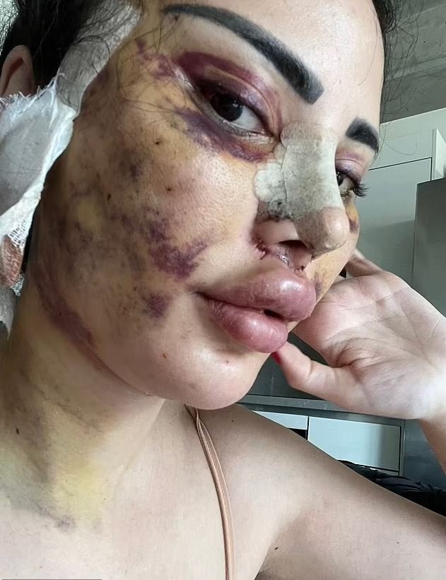 Το πρόσωπό της μετά από πλαστική επέμβαση