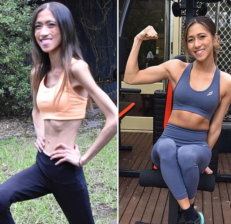 το πριν και το μετά την ανορεξία