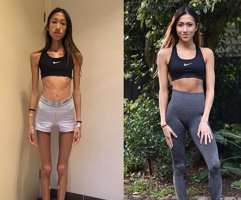 φωτογραφίες της Σάρα από τότε που είχε ανορεξία