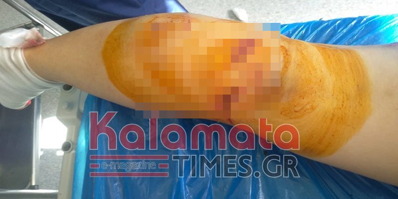 Καλαμάτα: Τα βαθιά σημάδια που άφησαν οι σκύλοι στην άτυχη 34χρονη / Φωτογραφία: kalamatatimes.gr
