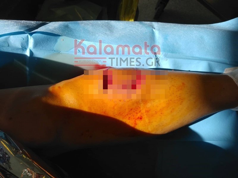 Καλαμάτα: Τα βαθιά σημάδια που άφησαν οι σκύλοι στην άτυχη 34χρονη / Φωτογραφία: kalamatatimes.gr