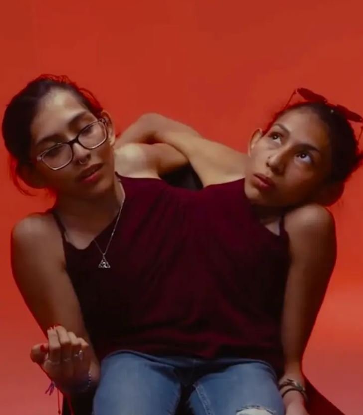 Η Κάρμεν και η Λουπίτα Αντράντε είναι ενωμένες στο στήθος 