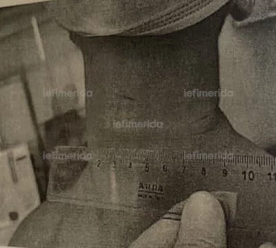 Φωτογραφία από το τραύματα από την πετονιά στο λαιμό του μαθητή στο Αρσάκειο
