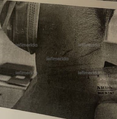 Φωτογραφία από το τραύματα από την πετονιά στο λαιμό του μαθητή στο Αρσάκειο