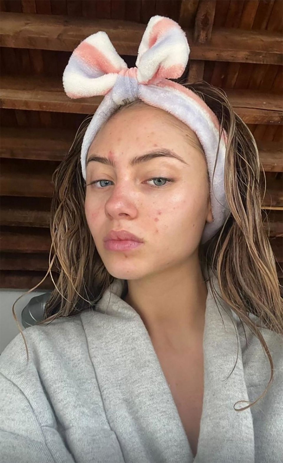 H selfie της Λένι Κλουμ άβαφη δείχνει σπυράκια