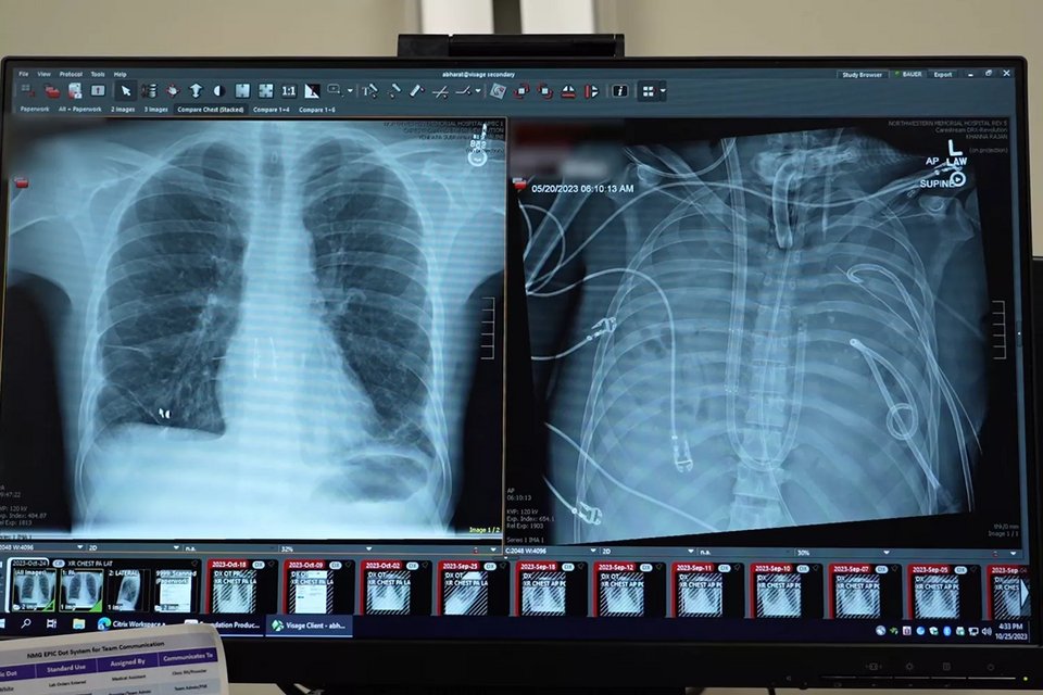 Οι παλιοί πνεύμονες του Bauer (δεξιά) και οι νέοι πνεύμονές του