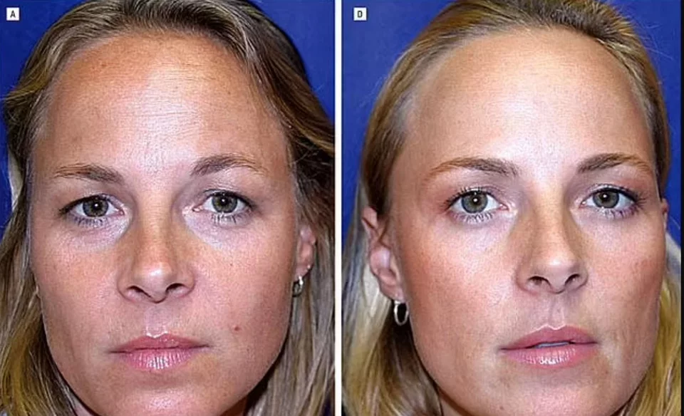 Η διαφορά στα 13 χρόνια botox. Αριστερά η δίδυμη που δεν έκανε, δεξιά η δίδυμη που έκανε botox. Η φωτογραφία από το 2006 όταν ήταν 38 ετών.