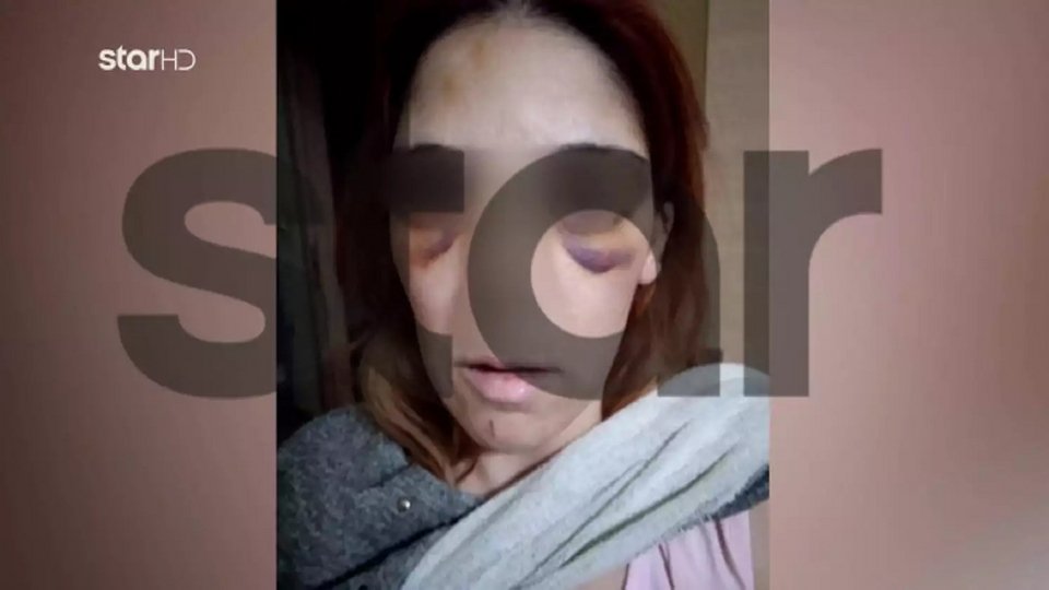 Σοκαριστική εικόνα της 32χρονης μετά την κακοποίηση / Star
