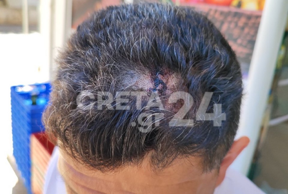 Τα τραύματα του 58χρονου πατέρα από την επίθεση στο μίνι μάρκετ / creta24.gr