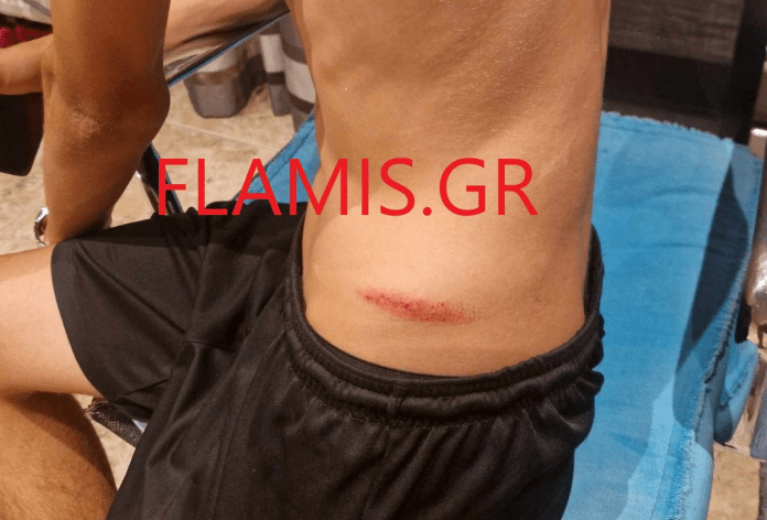 Τα τραύματα του 14χρονου στην Πάτρα / flamis.gr