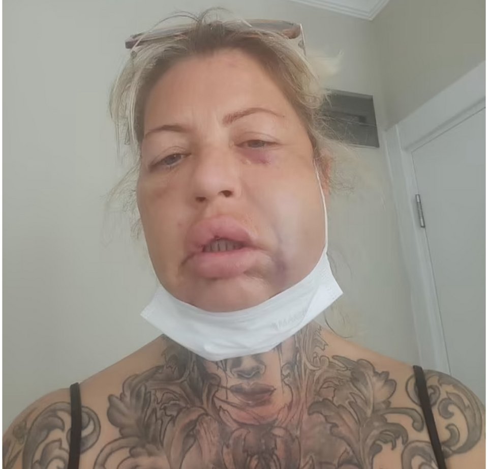 Η Βίκυ Ρόμπινσον πριν και μετά την επέμβαση ατην Τουρκία