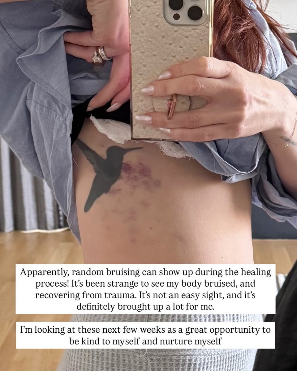 Οι μελανιές από την επέμβαση